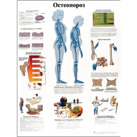 Остеопороз