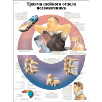 Травма ускорения-замедления шейного отдела позвоночника