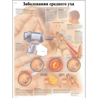 Заболевания среднего уха