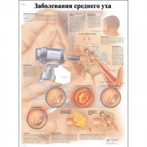 Заболевания среднего уха