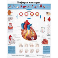 Инфаркт миокарда