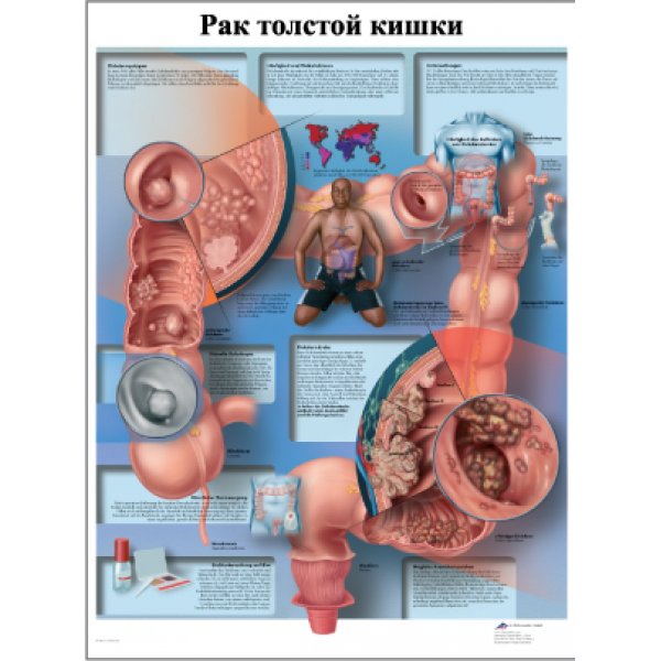 плакат Рак толстой кишки